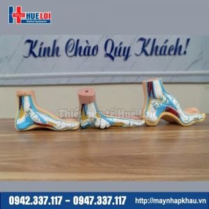 Mô Hình Bàn Chân Bệnh Lý Charcot Trong Tiểu Đường