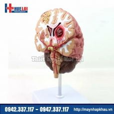 Mô hình bệnh lý não hay gặp