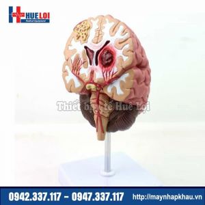 Mô hình bệnh lý não hay gặp