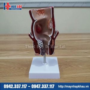 Mô hình hậu môn trực tràng bệnh lý
