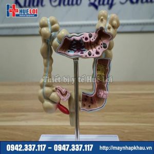 Mô hình các bệnh lý đại tràng hay gặp