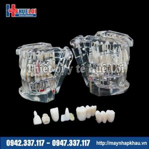 Mô hình răng bình thường và bệnh lý