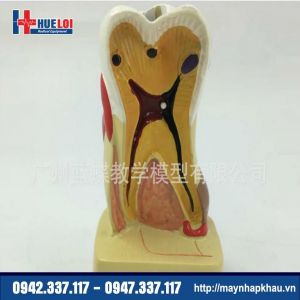 Mô hình răng bệnh lý