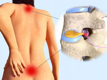 Thoát vị đĩa đệm là gì? nguyên nhân và cách phòng tránh